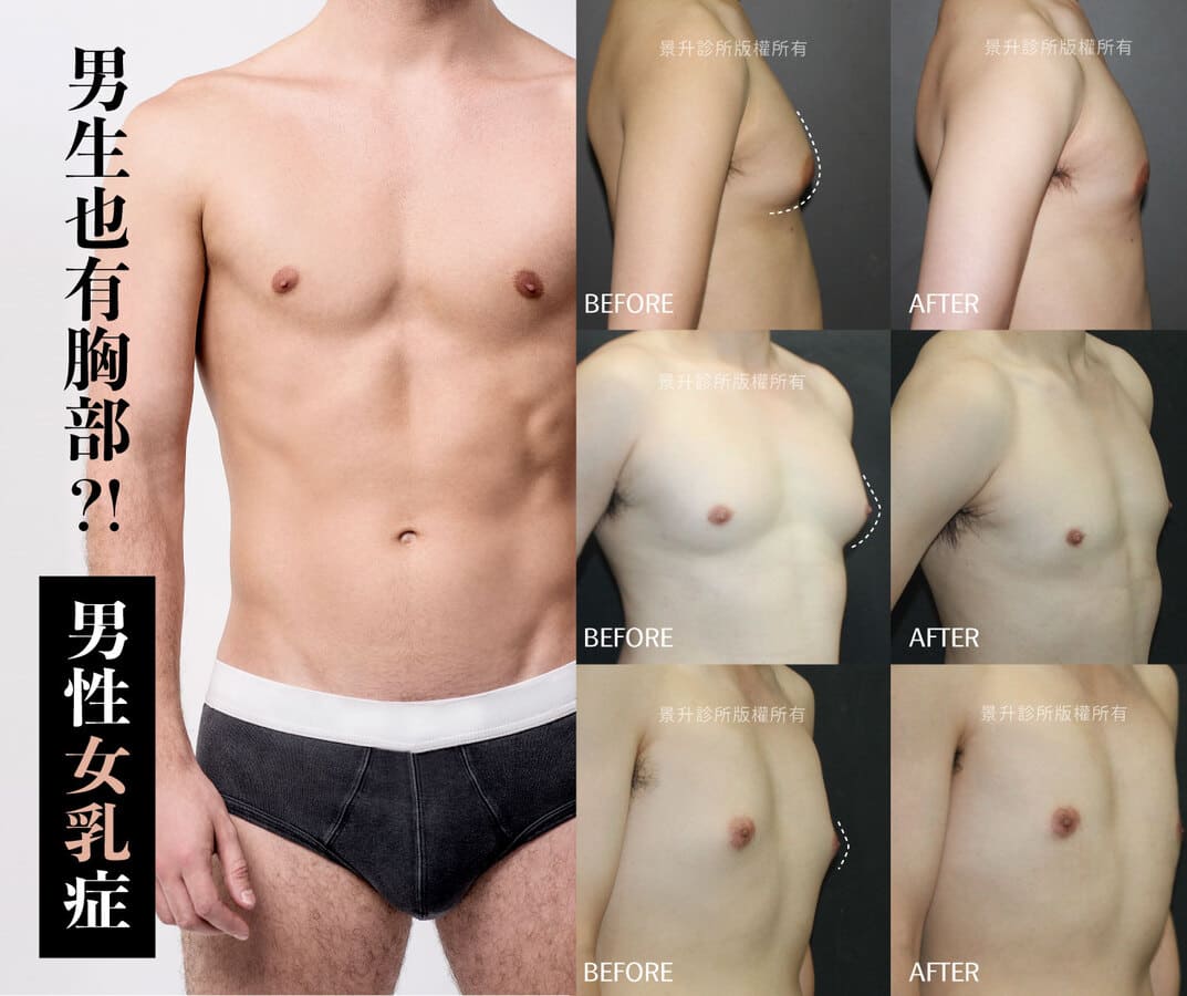 gynecomastia-case (2)